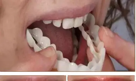 SwiftSmile Teeth Brace