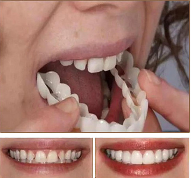 SwiftSmile Teeth Brace
